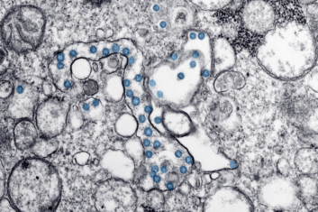 CDC image showing Transmission electron microscopic image of an isolate from the first U.S. case of COVID-19, formerly known as 2019-nCoV. The spherical viral particles, colorized blue, contain cross-sections through the viral genome, seen as black dots.